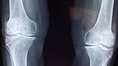Osteoporose bij borstkanker